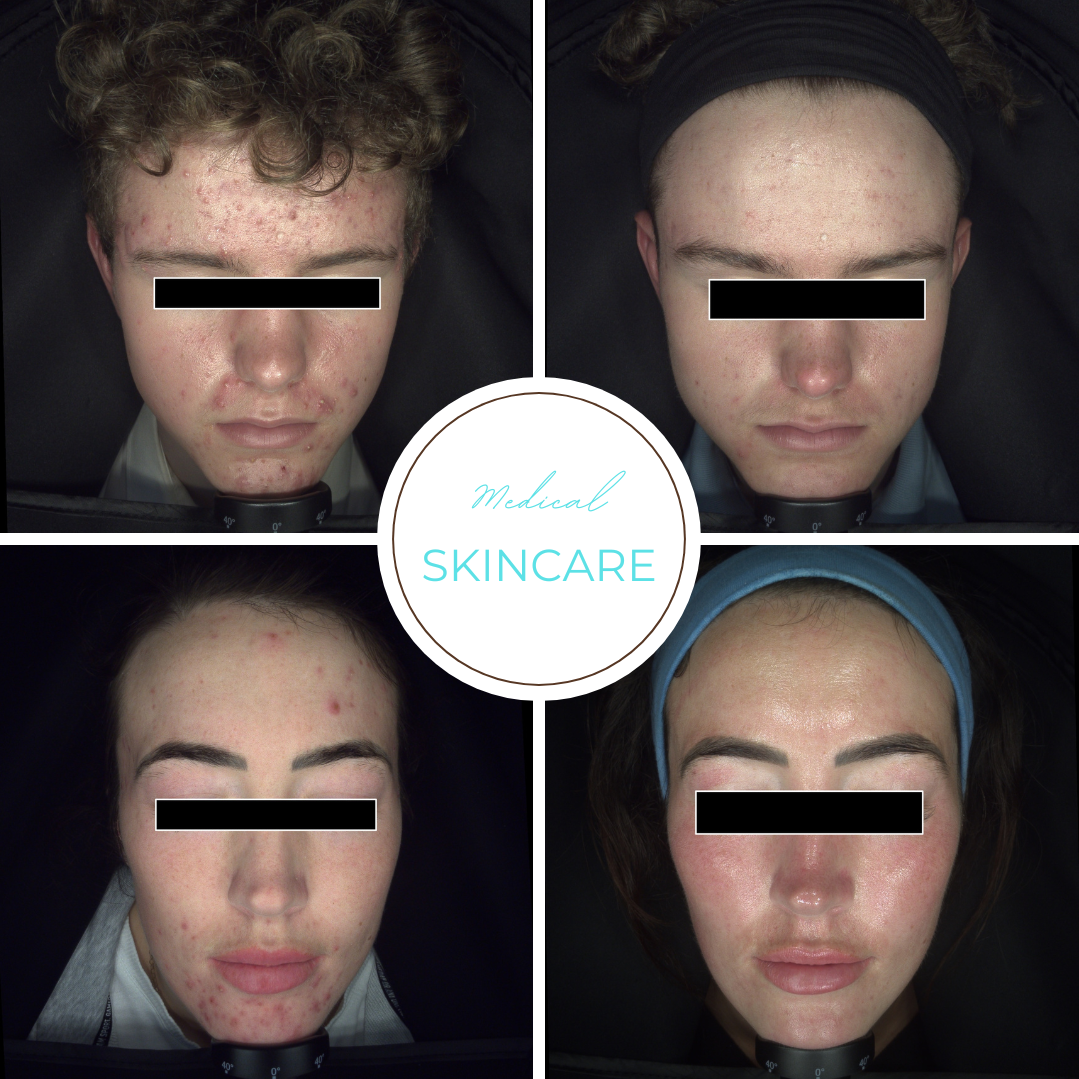 Nurse Lee Cosmetics Medical Skincare Halesowen Nurse Lee Cosmetics Medical Skincare Botox Dermal Fillers Skin Boosters Skin Treatment Acne Treatment Halesowen